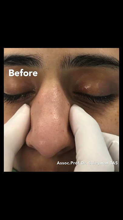 Wide Nose | Closed Atraumatic Rhinoplasty