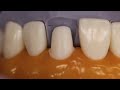 PFM Anterior Tooth Preparation