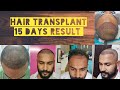 Hair transplant, 15 Days result