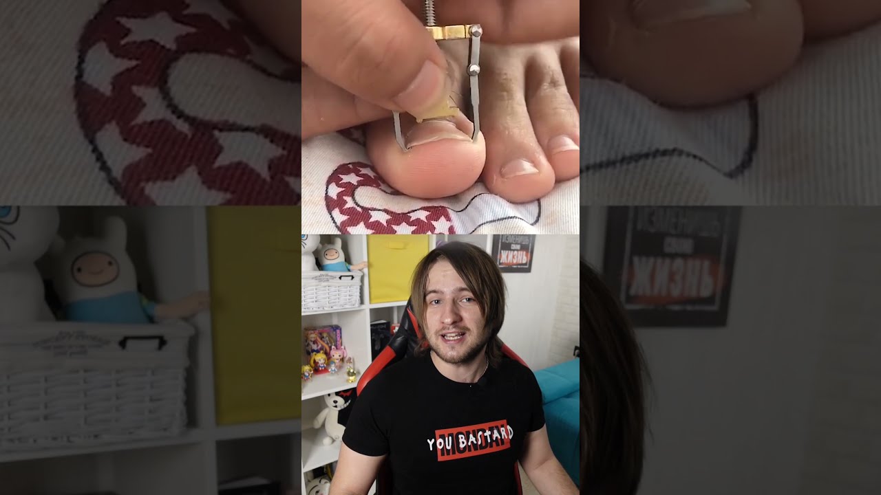 Самое необычное устройство для вросших ногтей!