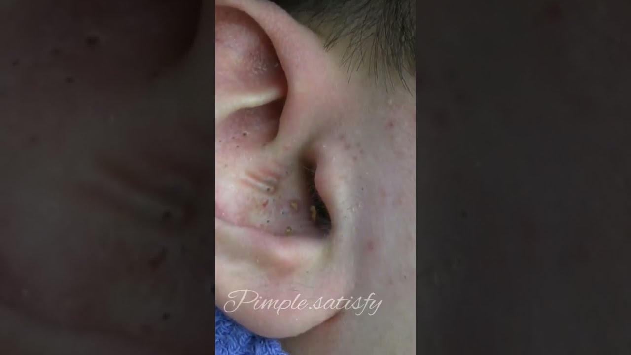 Pimple.Statisfy Video blackhead Removal in the ear010acne pimples