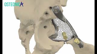 Revision total hip arthroplasty