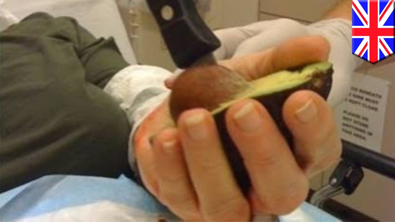Avocado hand: Gory Instagram trend of avocado-slicing accidents has physicians concerned