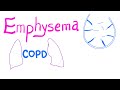 Emphysema | COPD | Pulmonary Medicine