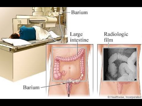6 BARIUM ENEMA اشعه الباريوم علي القولون 