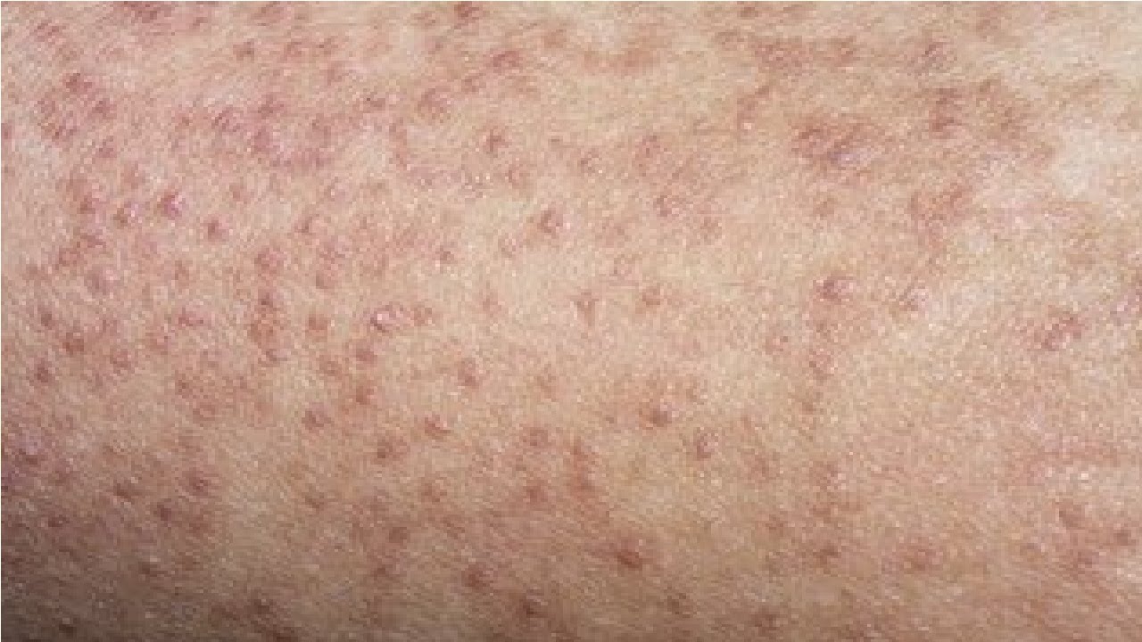 Keratosis Pilaris Organic Treatment See Now Keratosis Pilaris