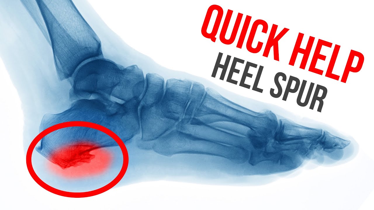 Details more than 126 heel spur therapy exercises latest - jtcvietnam ...