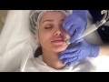 HYDRAFACIAL процедуры у косметолога и пилинг prx Т33