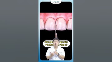 Khắc Phục Tam Giác Đen Ở Nướu Mà Không Làm Răng Sứ | Nha Khoa Minh Châu