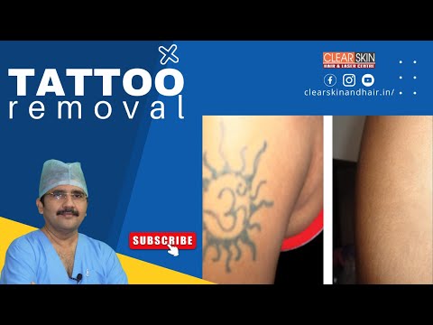 Laser Tattoo Removal Surgery in Bangalore  Dr Shettys Cosmetic Clinic