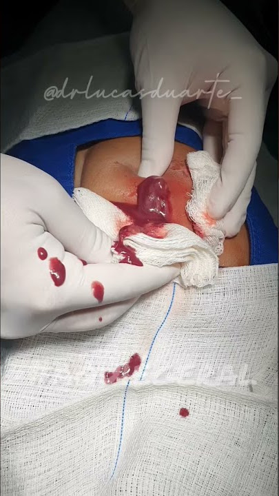 Drenagem de abscesso!🔥 🔪
