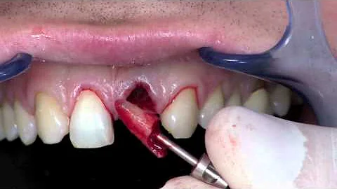 Formation en Implantologie et esthétique dentaire