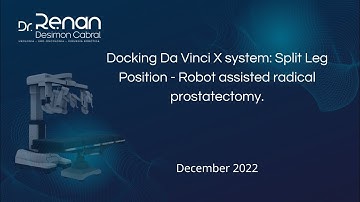 Docking Da Vinci X system: Split Leg Position  - Robot assisted radical prostatectomy.
