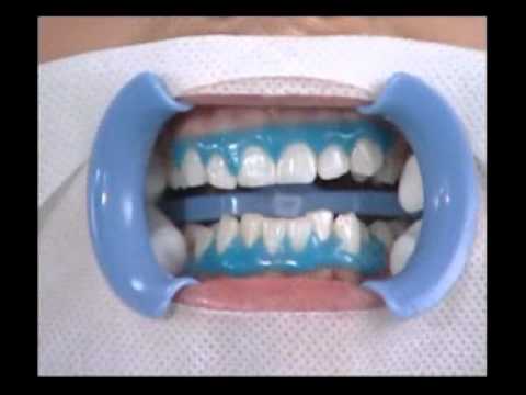 الاسنان جهاز تبييض جهاز تبيض
