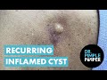 A Cyst That Keeps Coming Back For More!