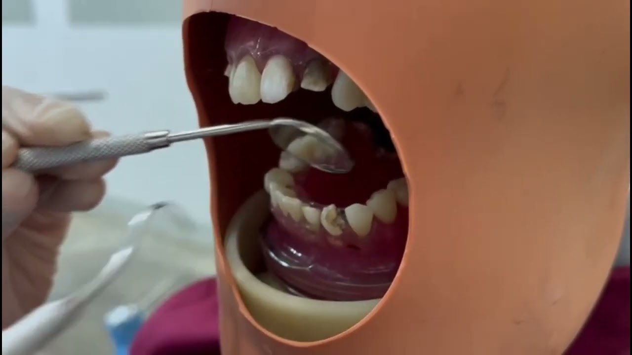 PENCABUTAN GIGI RADIX ANTERIOR RAHANG BAWAH PERMANEN (32) MENGGUNAKAN ANESTESI INFILTRASI