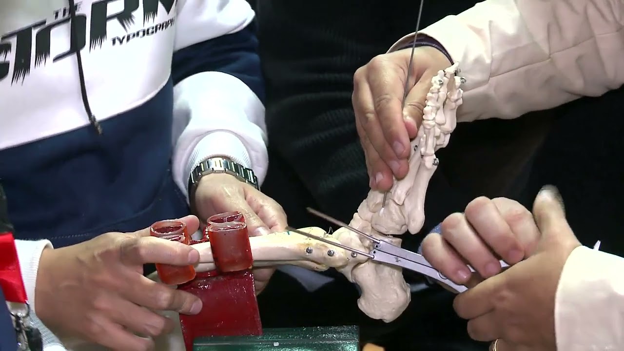 Day2 Workshop correction pesplanovalgus Lat column Lengthening - Mahmoud Abouzeid - george fouad