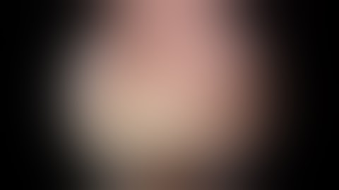 Arthroscopic Subscapularis Repair Using a Subacromial View