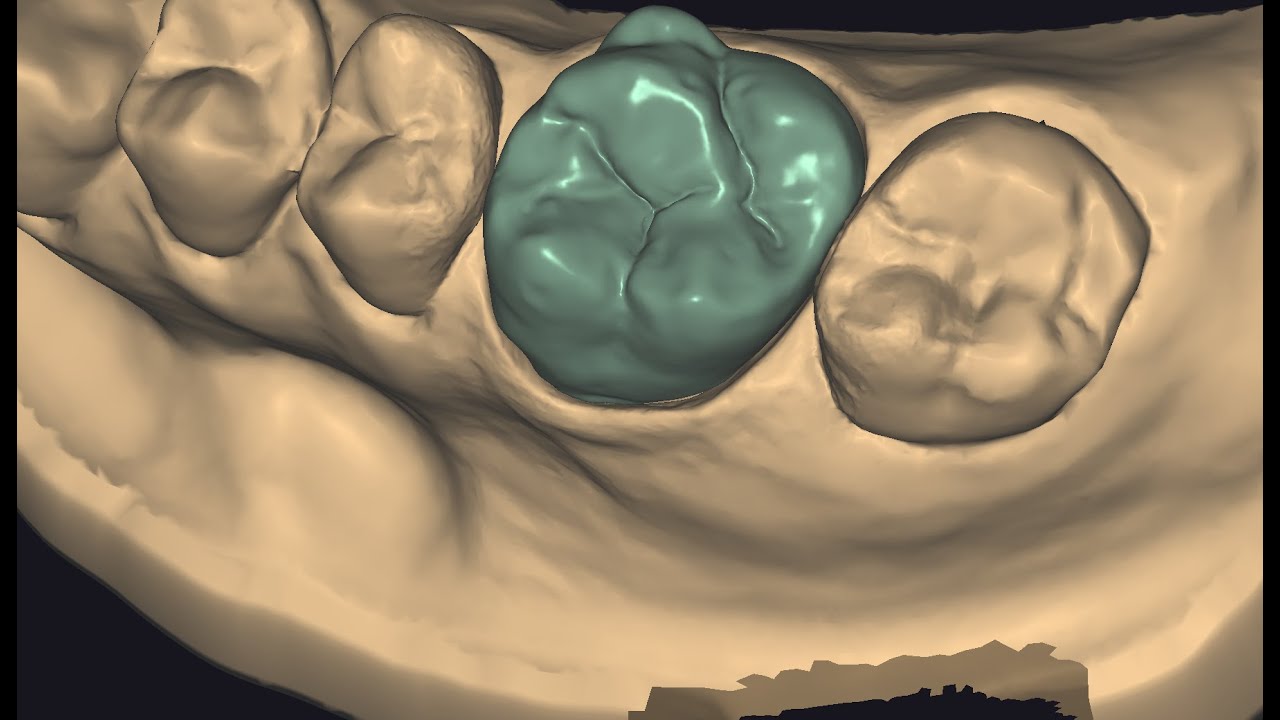 Nivel 1 Exocad Iniciante