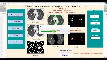 Lung Nodule Detection Using Image Processing Matlab Project with Source Code