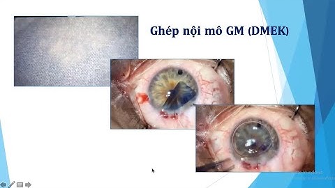 Các Yếu Tố Liên Quan Đến Sự Thành Công Của Phẫu Thuật Ghép Giác Mạc - TS.Vũ Tuệ Khanh