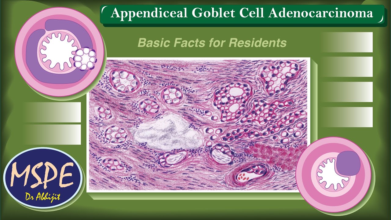 Appendix: Goblet Cell Adenocarcinoma (Basic Facts for Residents)