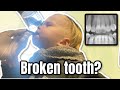 X-Ray for Broken tooth  | Meet the Millers Family Vlogs
