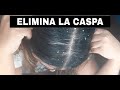 Elimina la caspa en 1 día / Remedio Casero para matar el hongo de la caspa