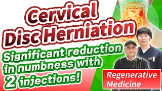【Cervical Disc Herniation】Regenerative Medicine for Residual Symptoms after Surgery