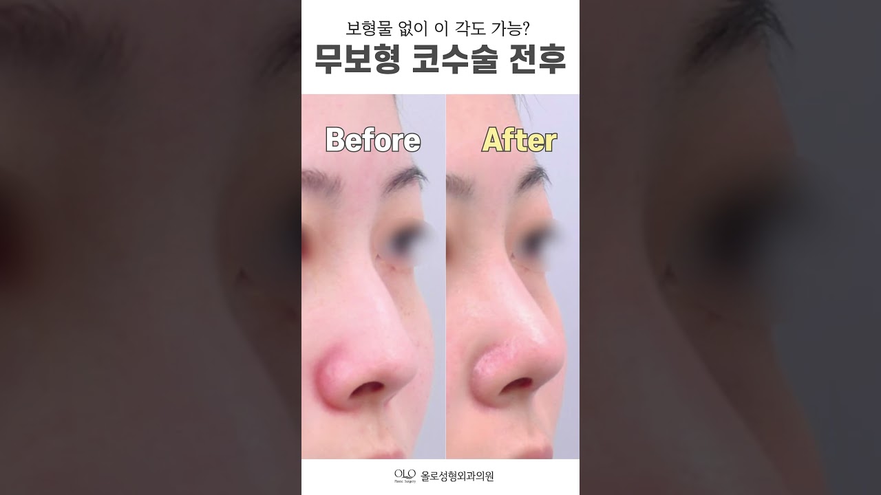 [オロ整形外科クリニック] プロテーゼなしでもこの #角度 ? #無プロテーゼ鼻整形 #shorts