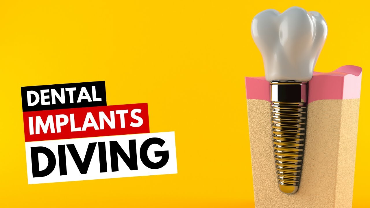 Dental Implants and Diving