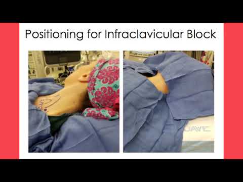 Infraclavicular Block