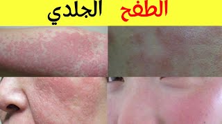 أسباب الطفح الجلدي و التسلخات الجلدية و حساسية الجلد أنواعها و كيفية الوقاية منها