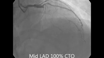 LAD CTO PCI