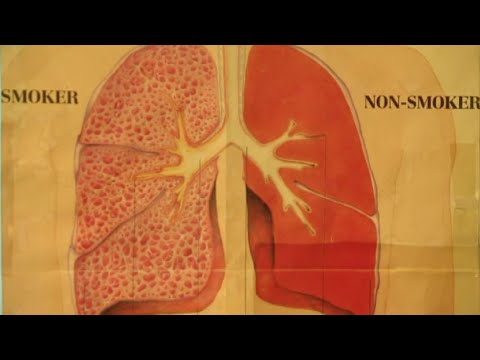 Video: Plućna Fibroza: Definicija I Obrazovanje Pacijenata