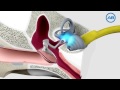 How A Cochlear Implant Works by Advanced Bionics