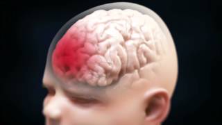 Shaken Baby Syndrome Brain Injury