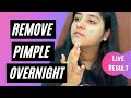 How to Remove Pimples Overnight | Acne Treatment | 100% Works | Live Result | Indian Healing Clay