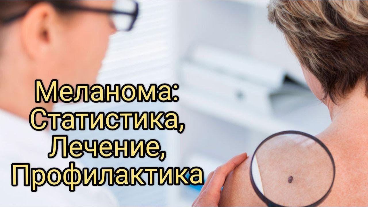 «Меланома: статистика, лечение и профилактика» - YouTube