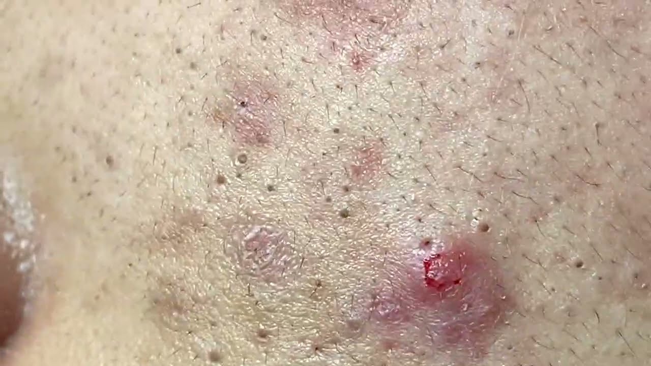 Acne Treatment Huong Da Nang#528  | 2023