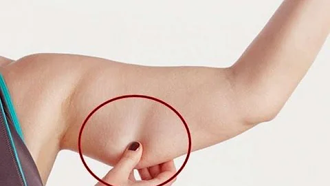 ¿Se puede eliminar la flacidez de la piel de los brazos sin cirugía?