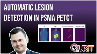 Celebrity Automatic lesion detection and segmentation in PSMA PETCT images using deep neural networks Wealth