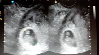 Meu Bebe Com Dois Meses Na Barriga Youtube