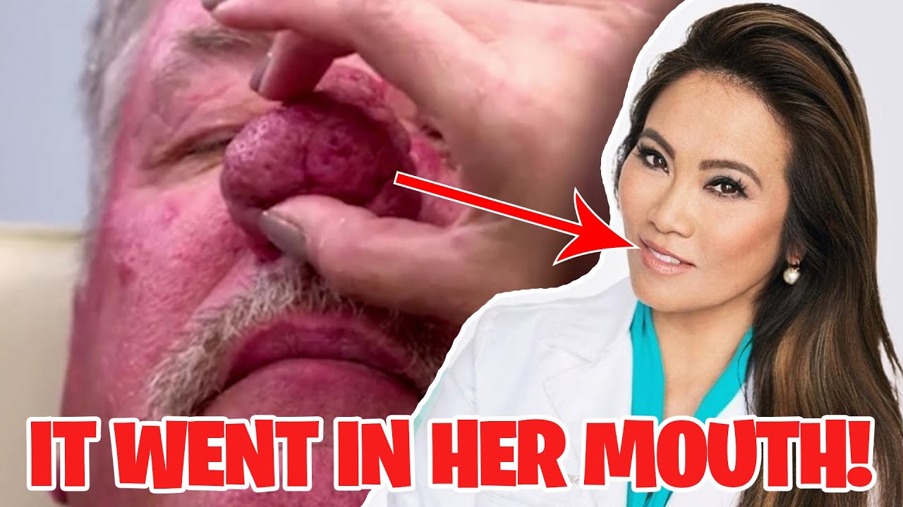 The BIGGEST BLACKHEADS EVER on Dr. Pimple Popper! YouTube