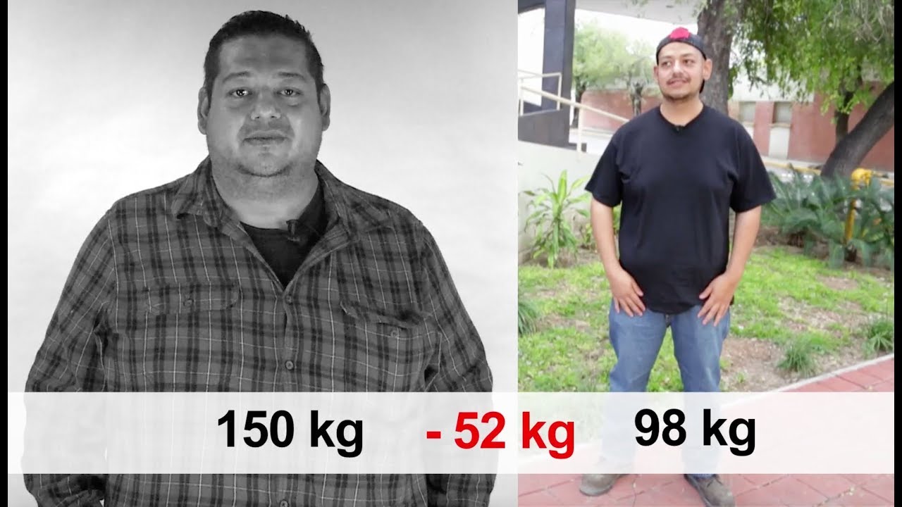 UN CAMBIO DE VIDA- 6 MESES DE LA CIRUGÍA DE PAUL / DR. SEBASTIANARANA GARZA, FACS.