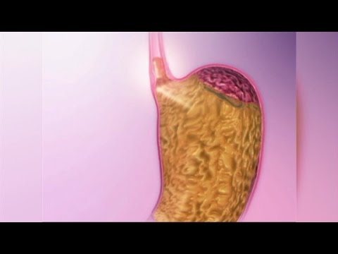 Video: Hoe zure reflux te behandelen: werken natuurlijke remedies?