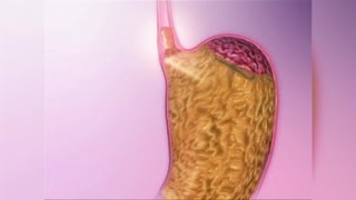 Acid Reflux Natural Remedies Resimi