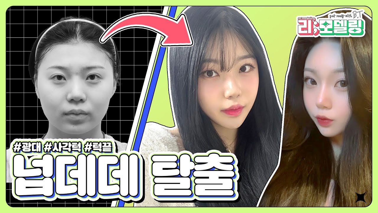 윤곽3종으로 넙데데 탈출 ㅣ비티성형외과