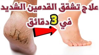 طريقه@عمل علاج لتشققات القدمين في يومين #مطبخ_سكر