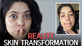 IRL Skin Transformation | COMEDONES + SKIN BARRIER DAMAGE